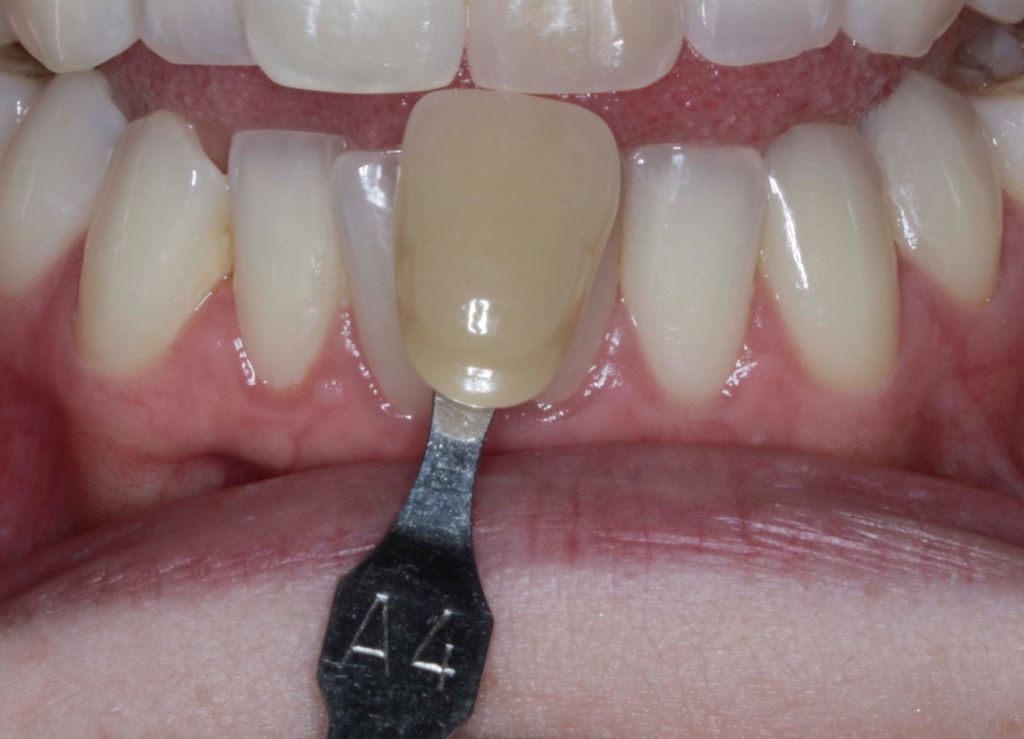 How do you prevent stains after teeth whitening