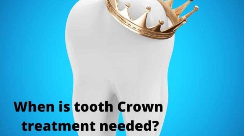 Can crowned teeth be whitened