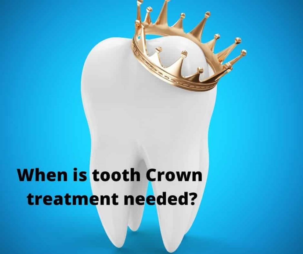 Can crowned teeth be whitened